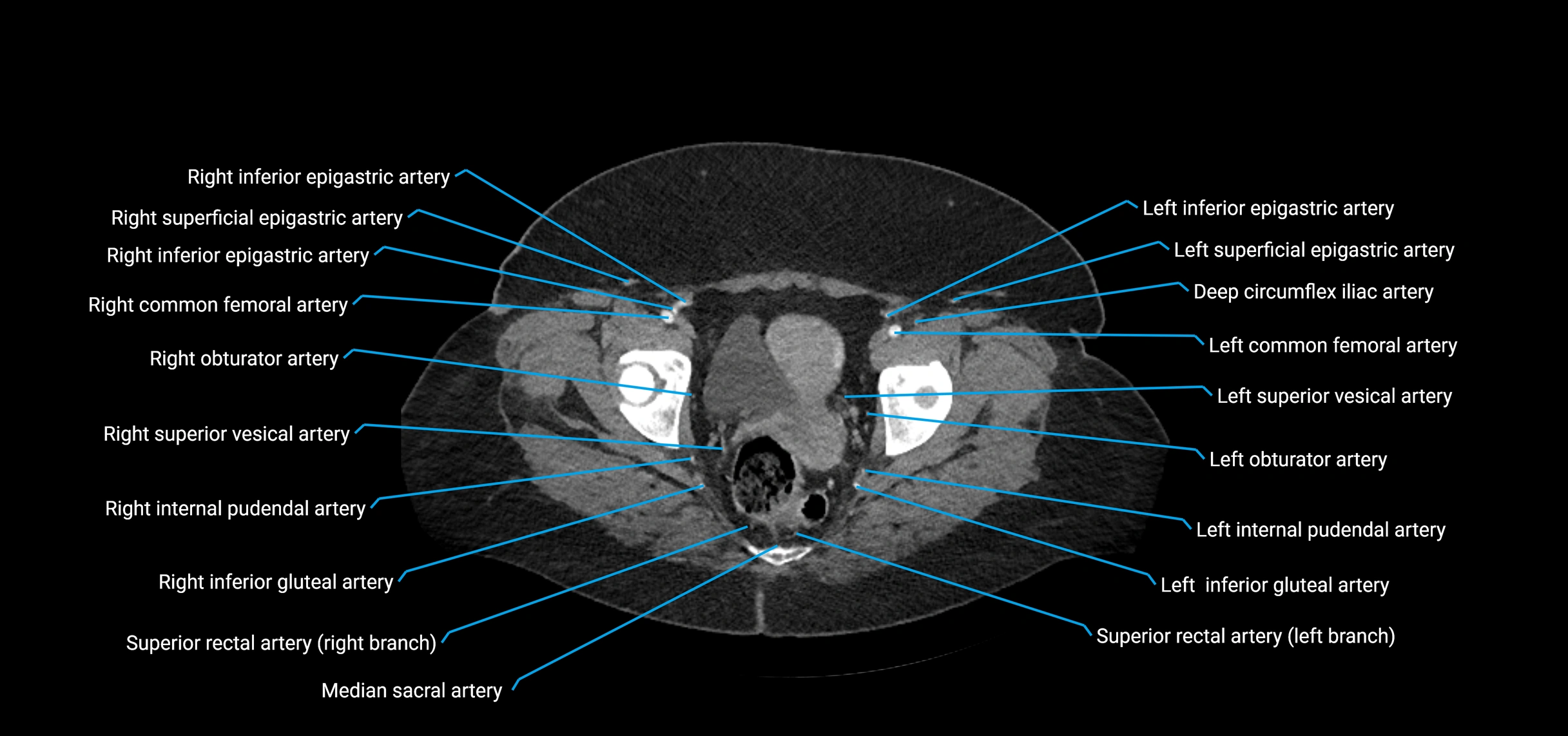 CTA abdomen axial cross sectional anatomy labelled image_235 (2).webp